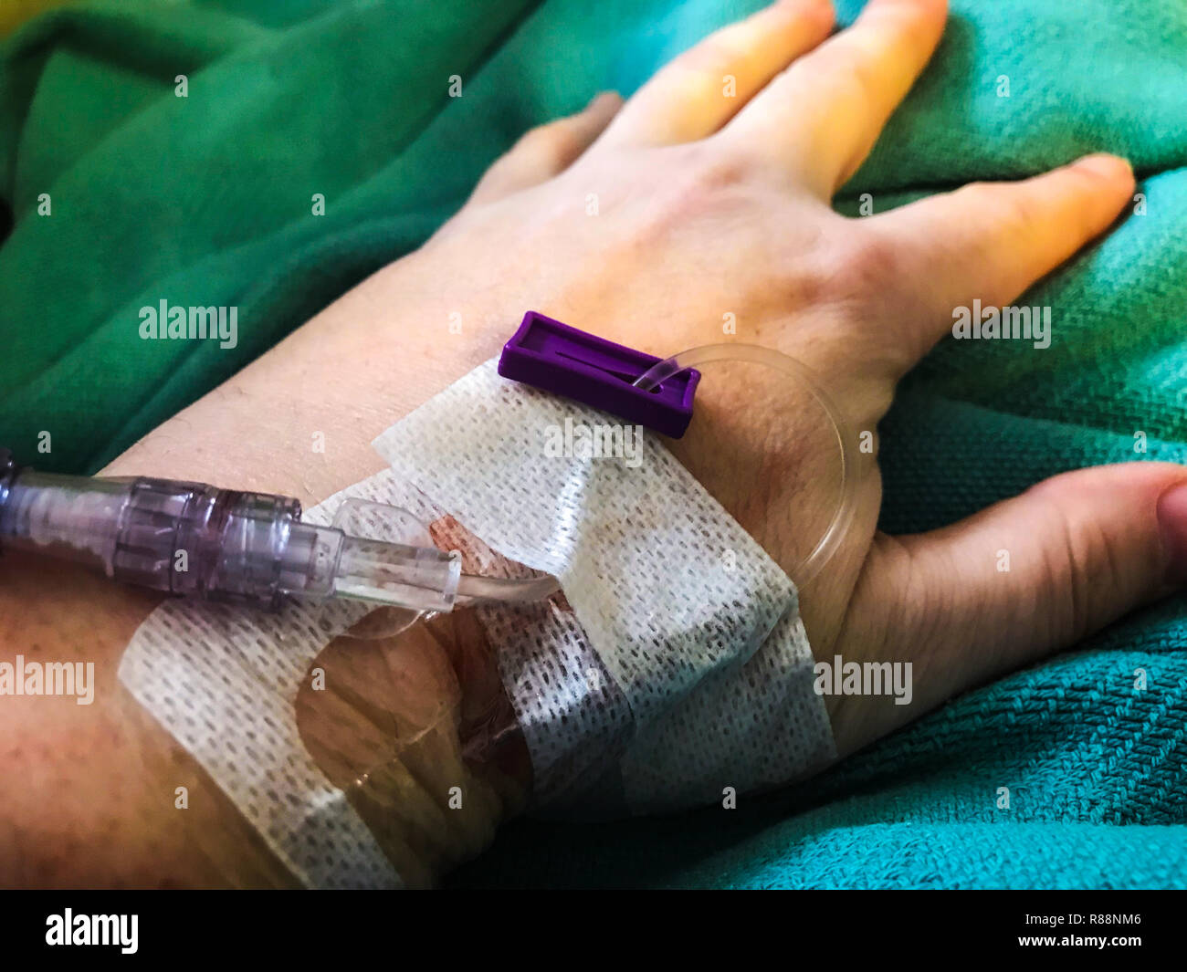 IV inserted into a vein in the wrist Stock Photo Alamy