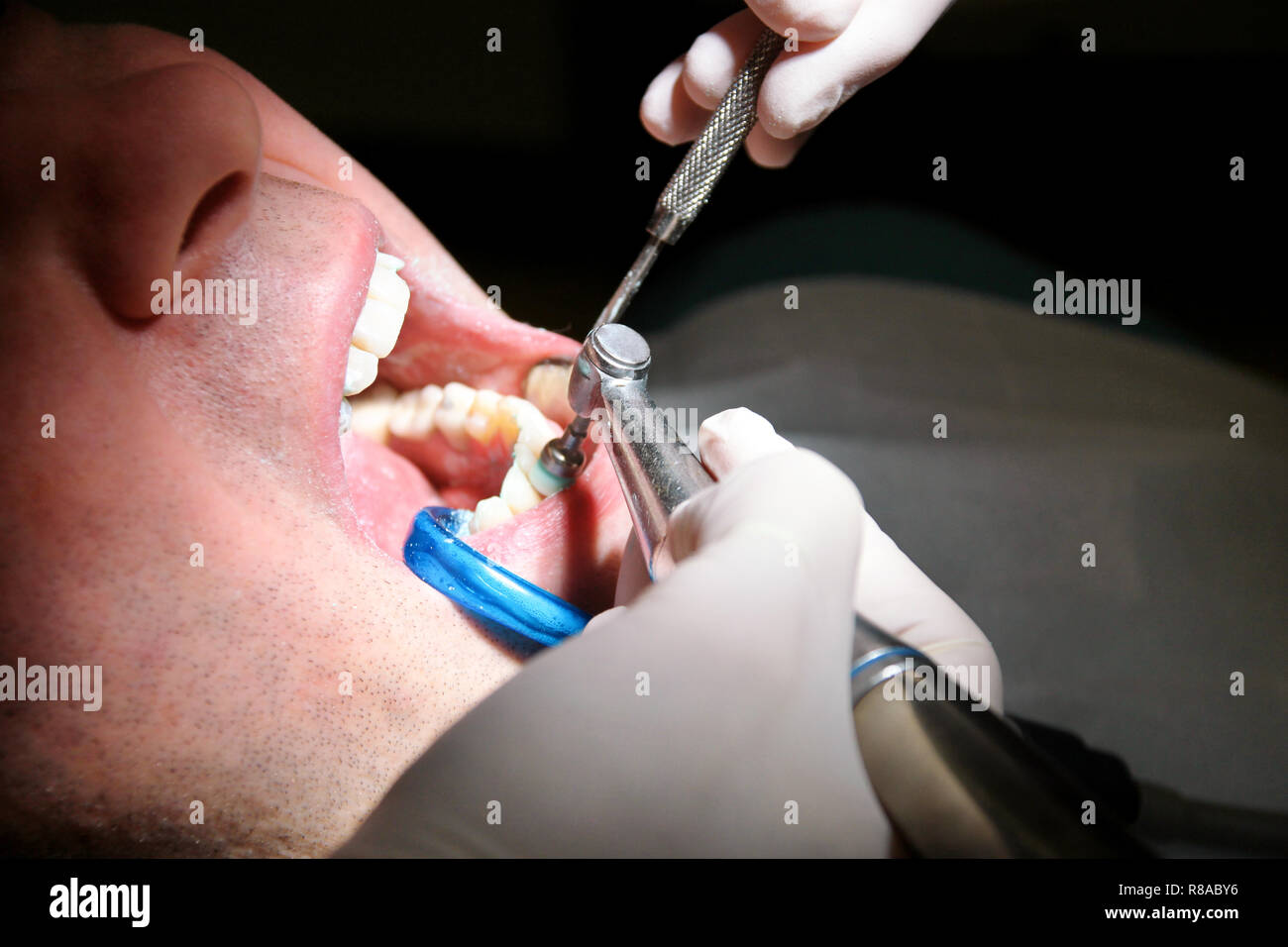 Dental tooth polishing. Teeth cleaning, dental hygiene. Dentist at work