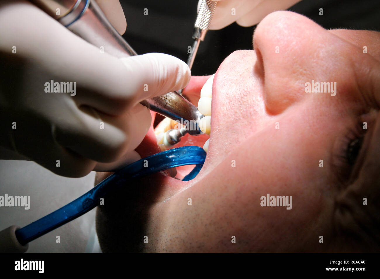 Dental tooth polishing. Teeth cleaning, dental hygiene. Dentist at work