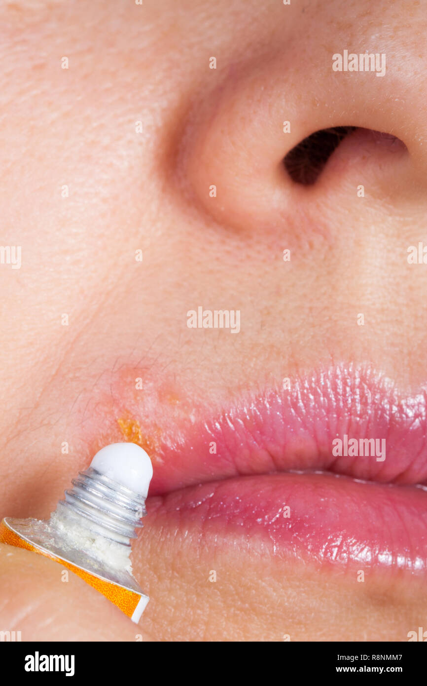 Herpes on the lip close-up macro. Woman lubricates the labial herpes ointment Stock Photo