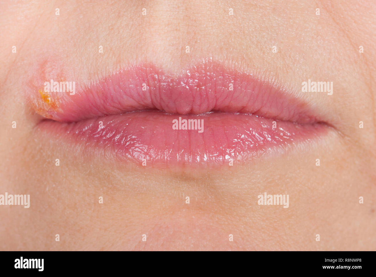 Herpes on the lip close up macro Stock Photo Alamy