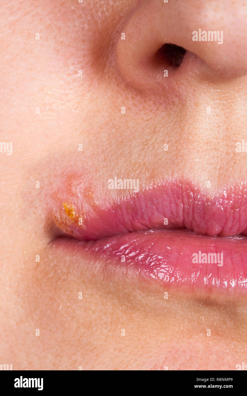 Herpes on the lip close up macro Stock Photo