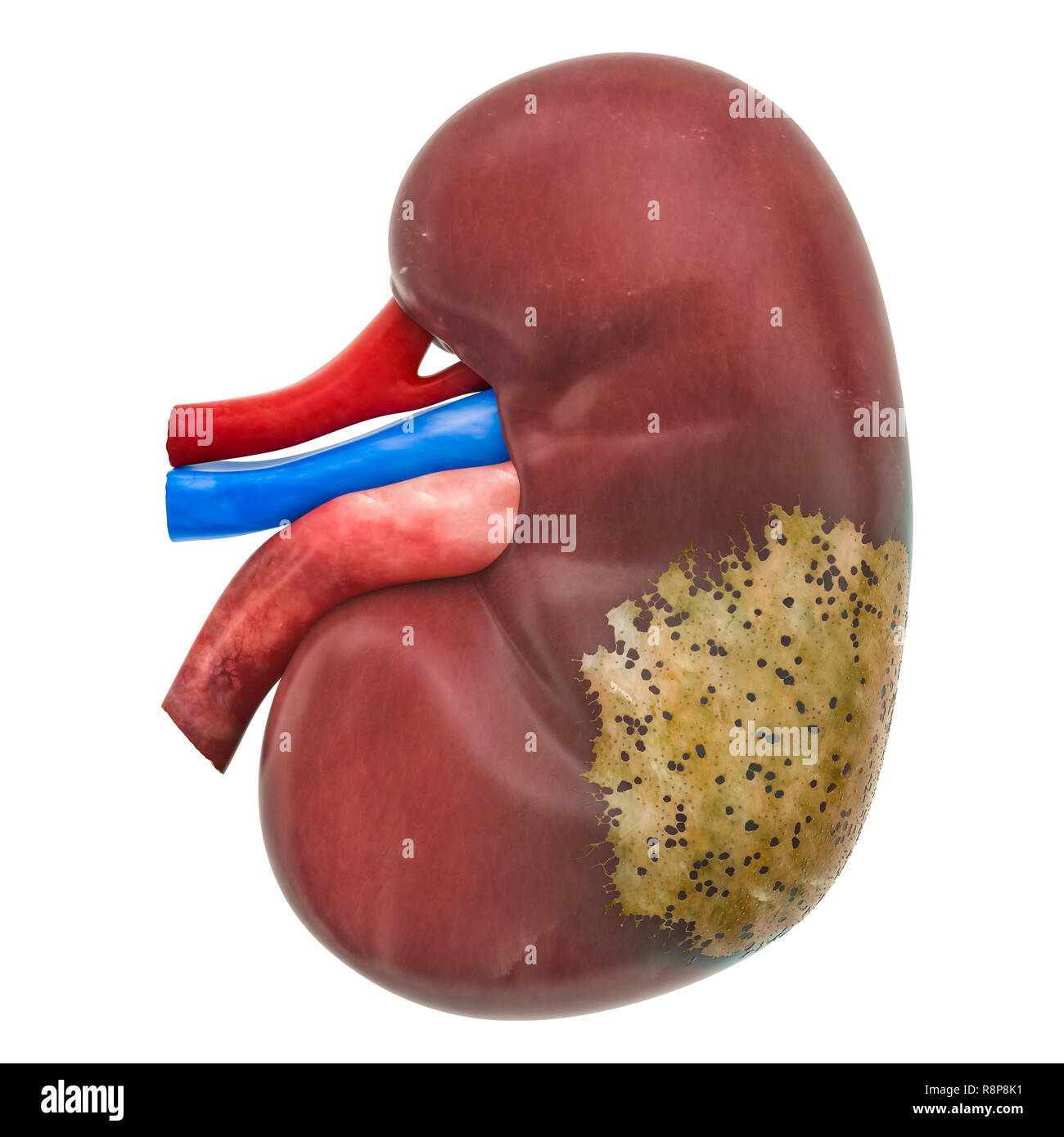 Kidney disease concept, 3D rendering isolated on white background Stock Photo