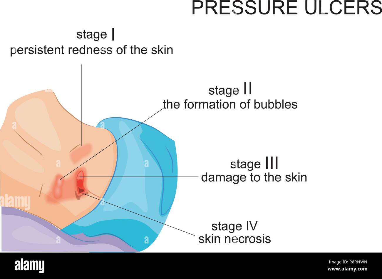 vector illustration of the stage of formation of bedsores Stock Vector