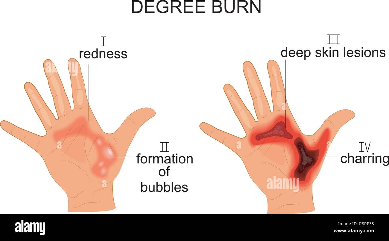 first degree burn hand
