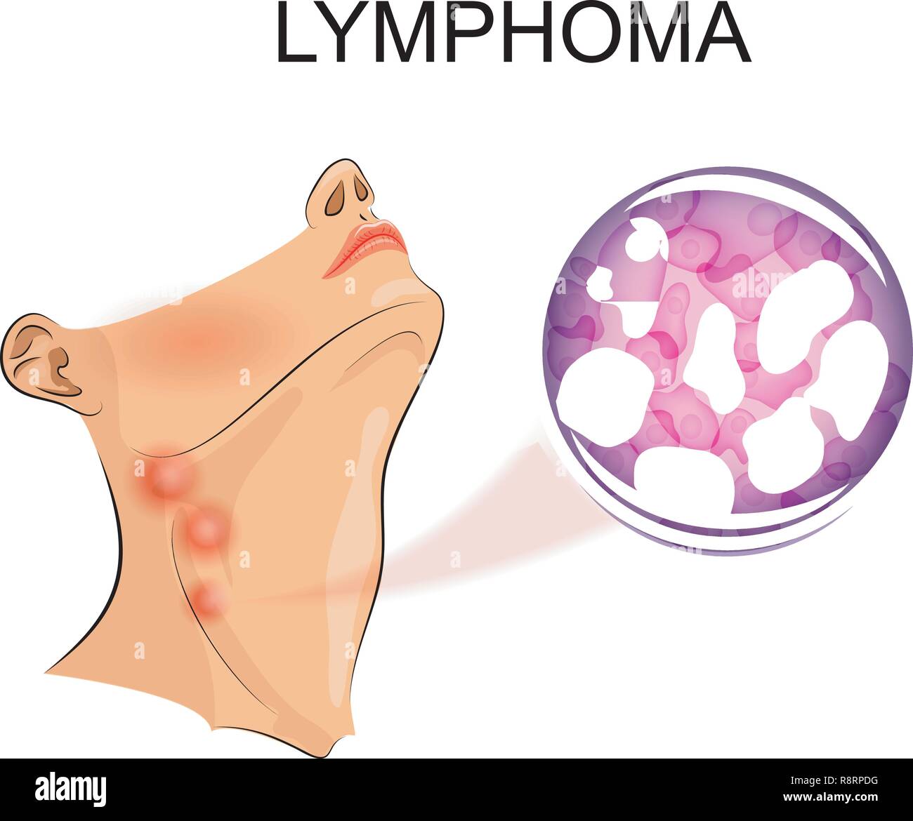 vector illustration of the increase in lymph nodes in lymphoma. Stock Vector