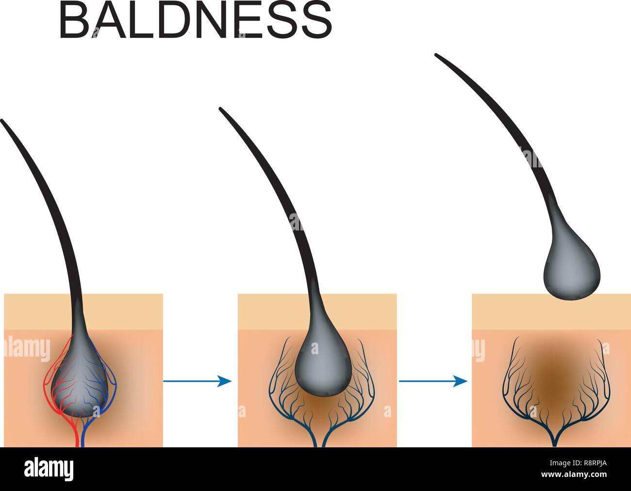 vector illustration of circulatory disorders in the hair follicle. baldness Stock Vector