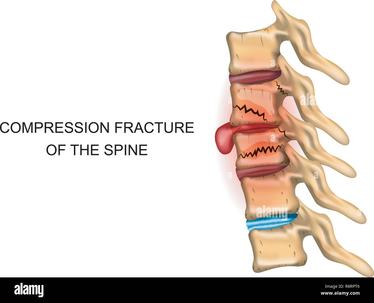 Compression fracture spine hires stock photography and images Alamy