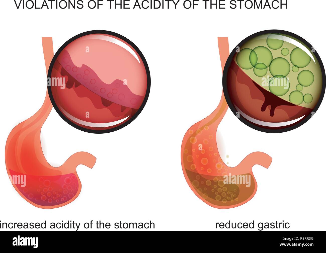 vector illustration of high and low acidity of the stomach Stock Vector