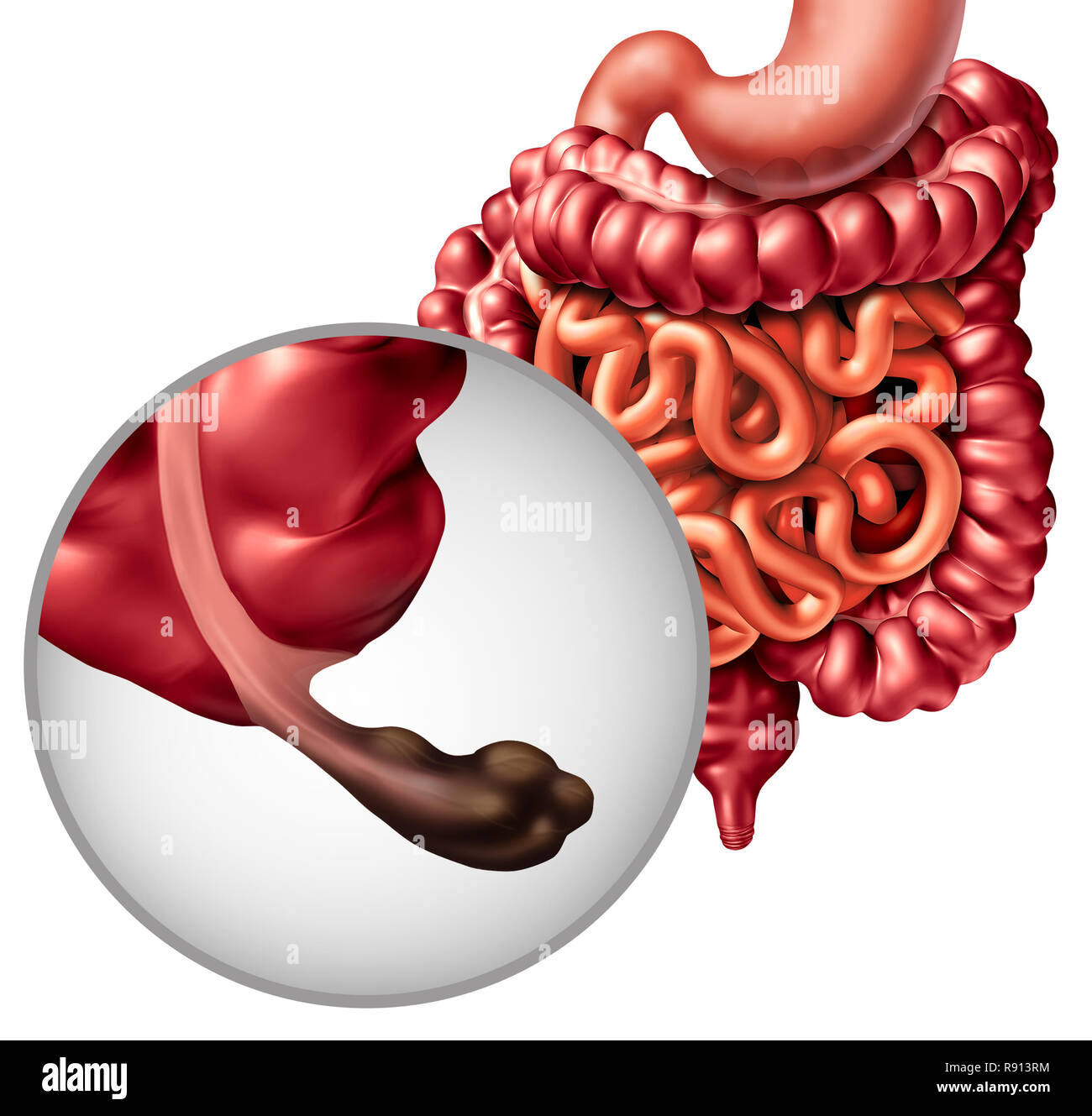 Appendix cancer and Intestine disease or gastrointestnal digestion with a malignant tumor symptoms and diagnosis problem as digestion discomfort. Stock Photo