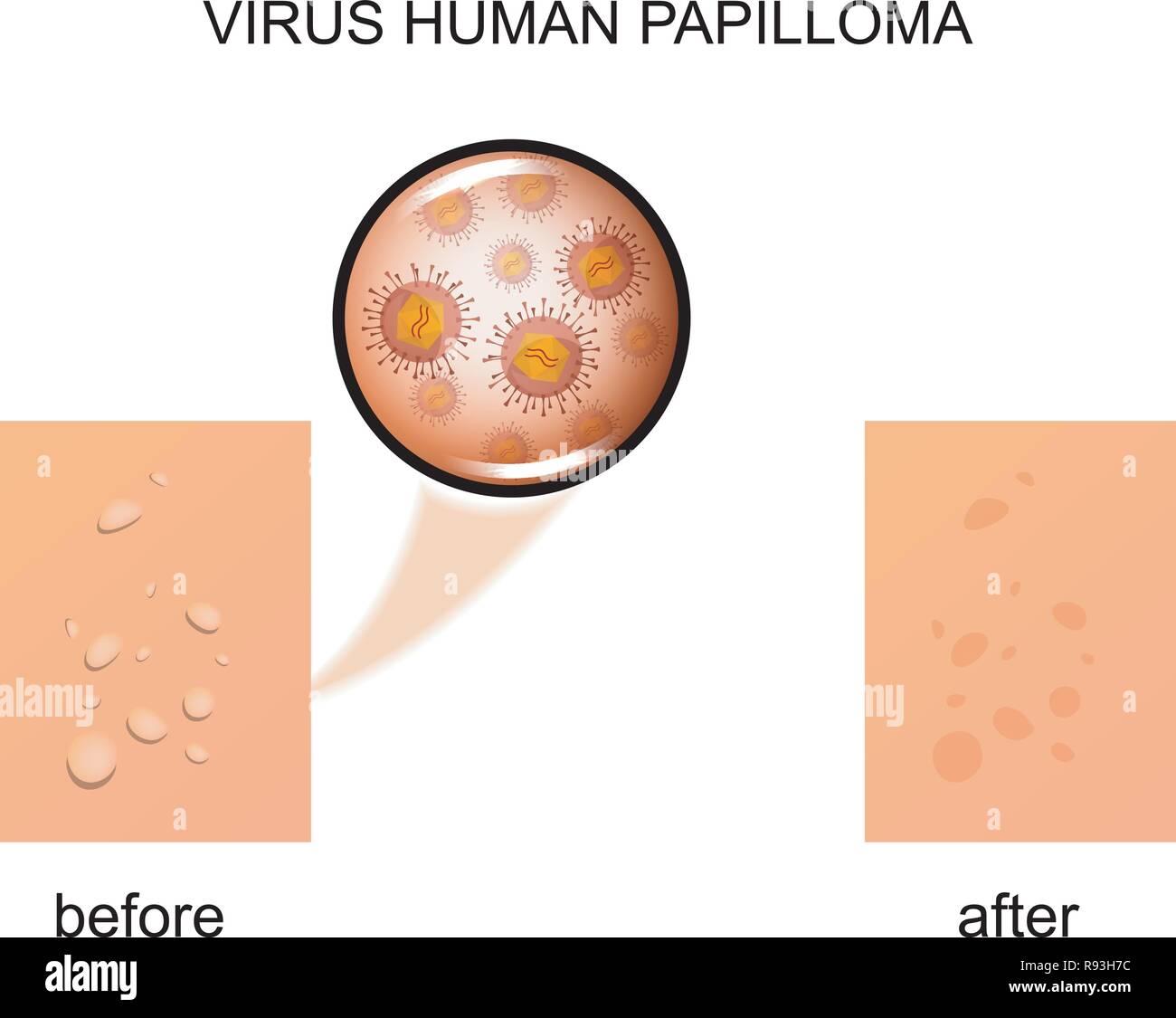 vector illustration of a human papilloma virus Stock Vector