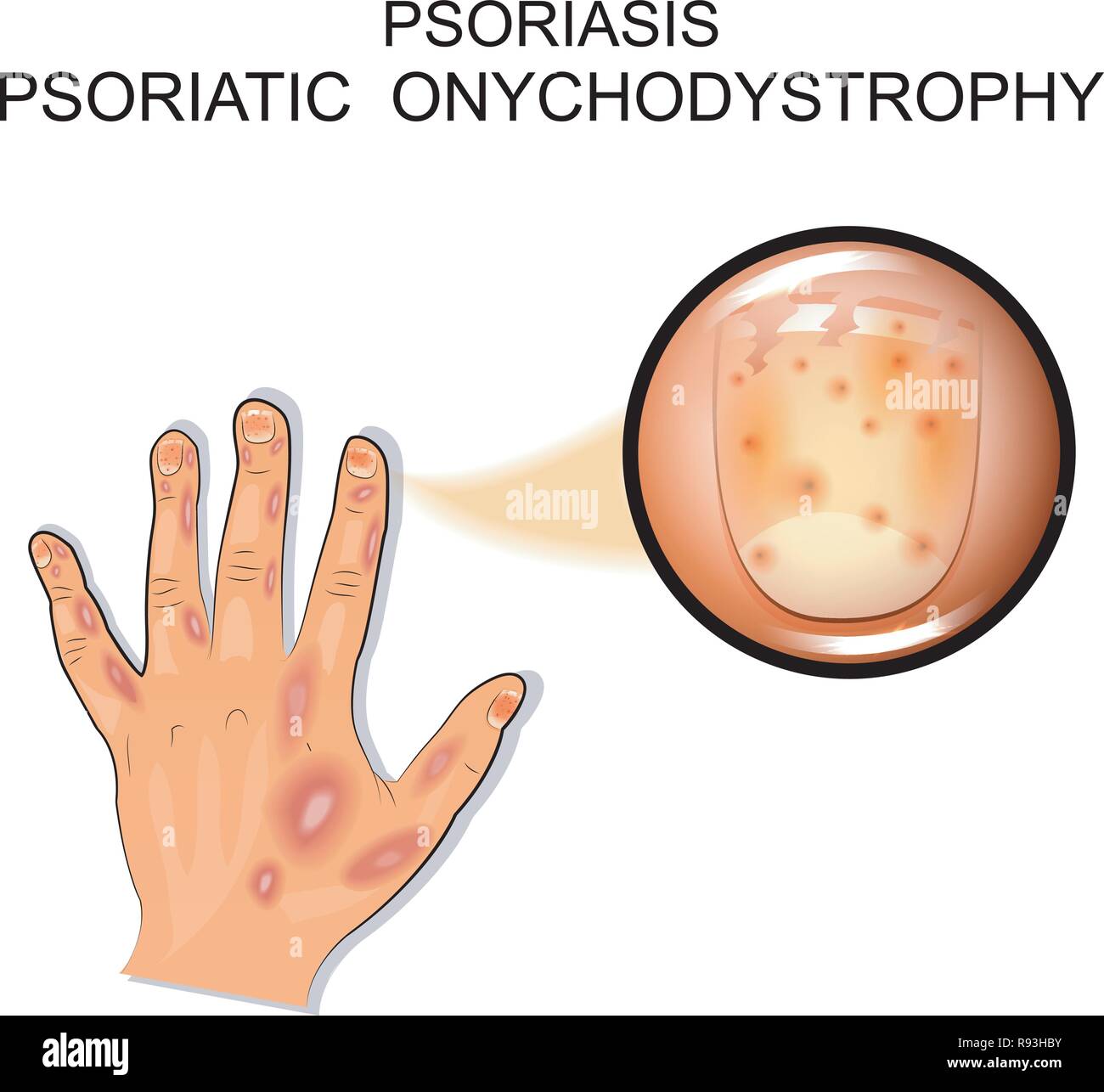 vector illustration of a psoriatic onychodystrophy. psoriasis. Stock Vector