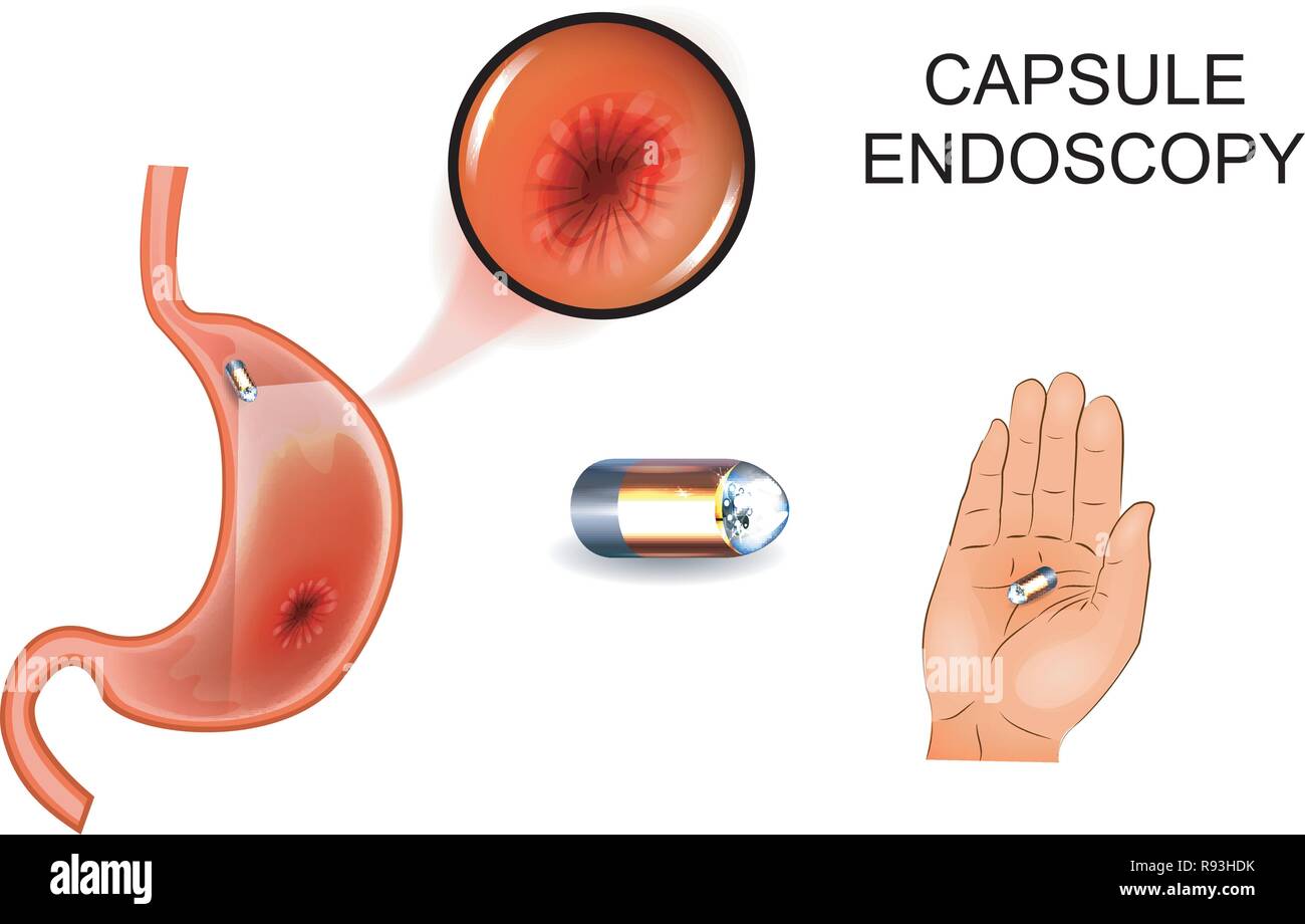 vector illustration of capsule endoscopy. EGD, gastroenterology 2 Stock Vector