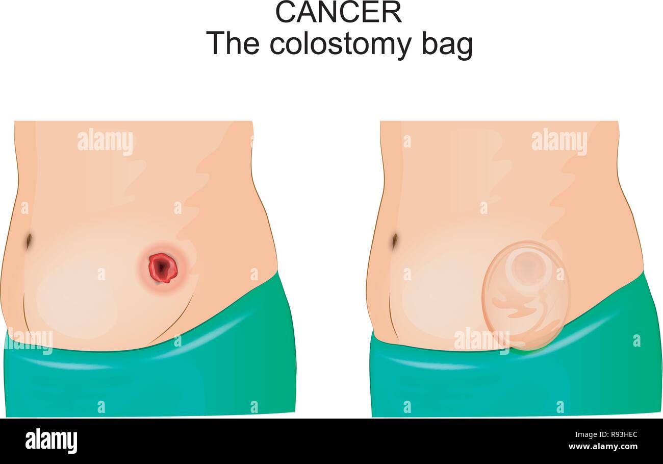 vector illustration of a colostomy bag after operation of colostomy Stock  Vector Image & Art - Alamy