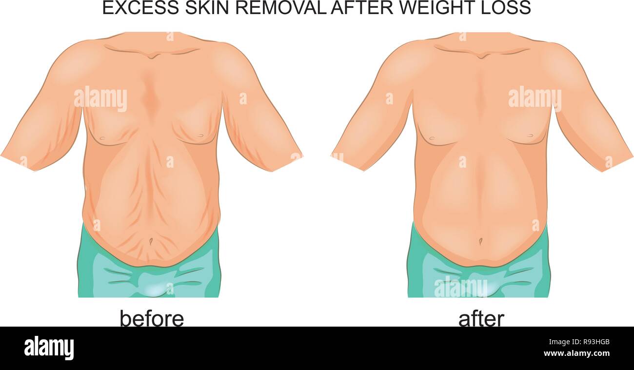 vector illustration of the removal of excess skin after weight loss Stock  Vector Image & Art - Alamy