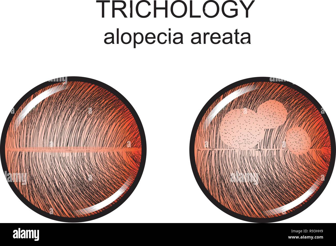 vector illustration of alopecia areata. trichology. dermatology Stock Vector