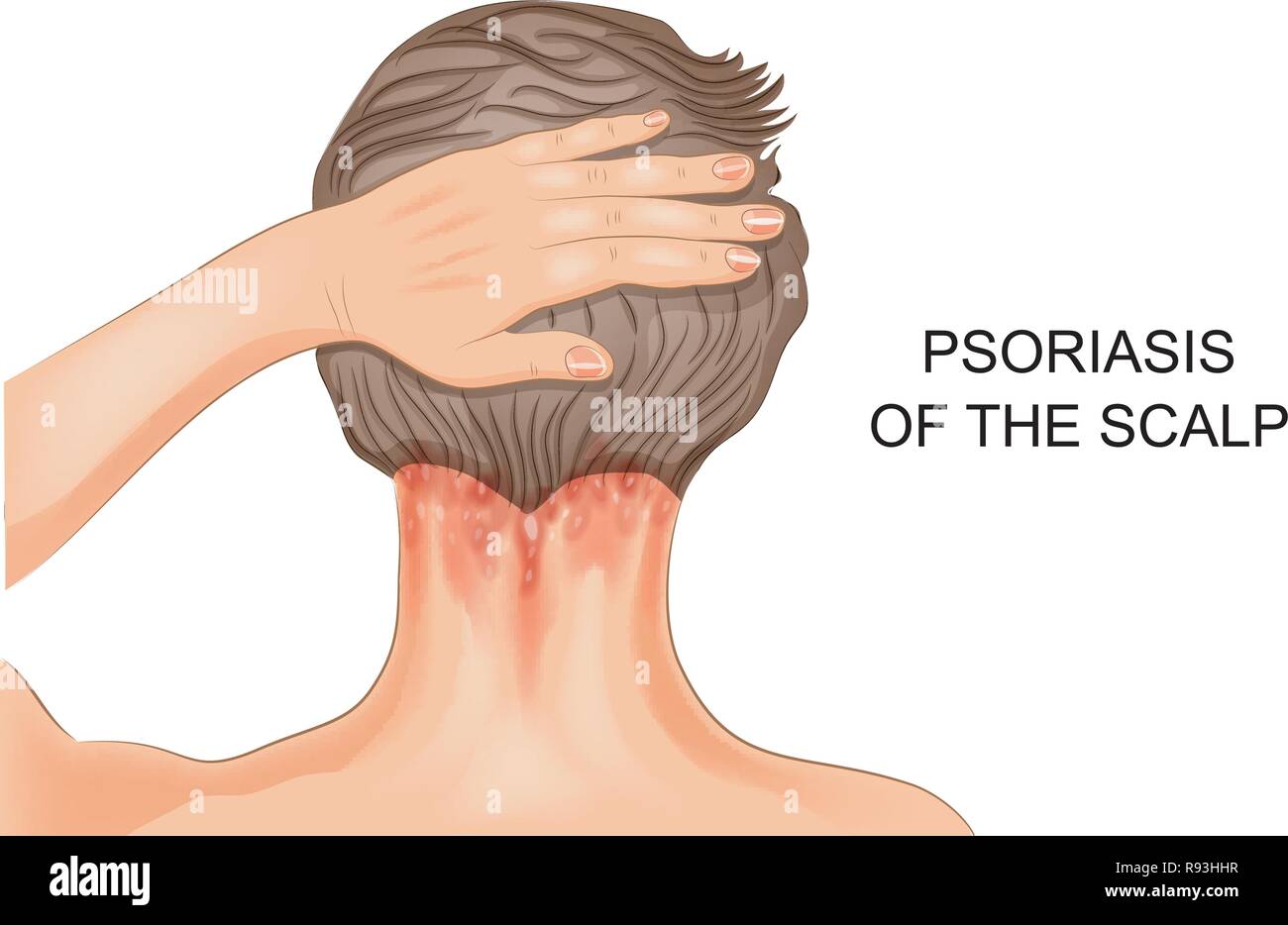 vector illustration of psoriasis of the scalp Stock Vector