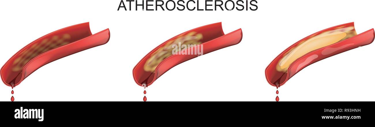 vector illustration of a vessel affected by atherosclerosis Stock Vector