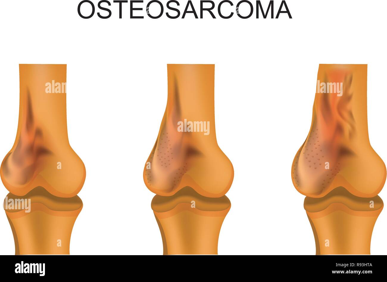 vector illustration of a femur affected by osteosarcoma Stock Vector