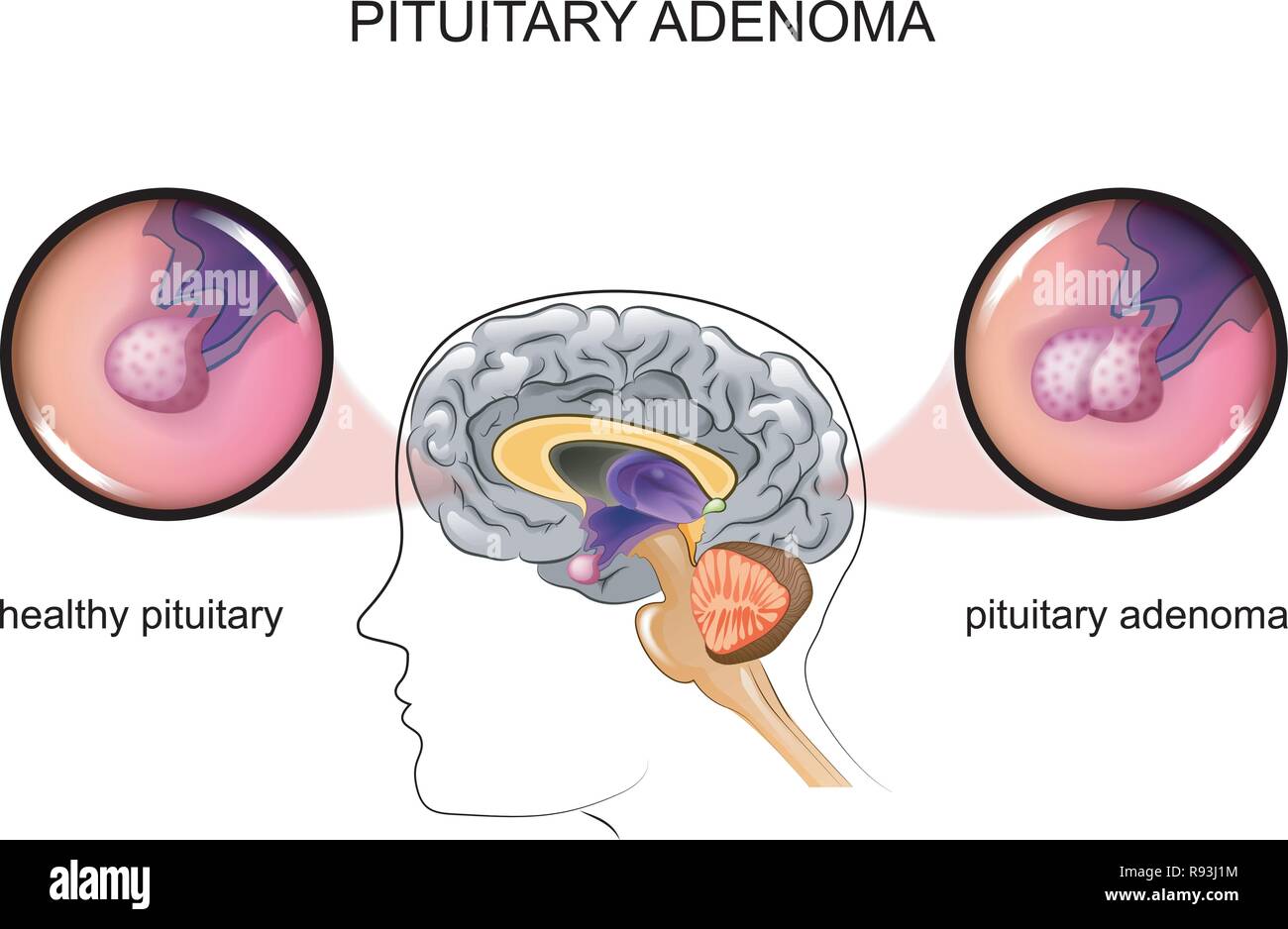 vector illustration of a healthy pituitary and pituitary adenoma Stock Vector