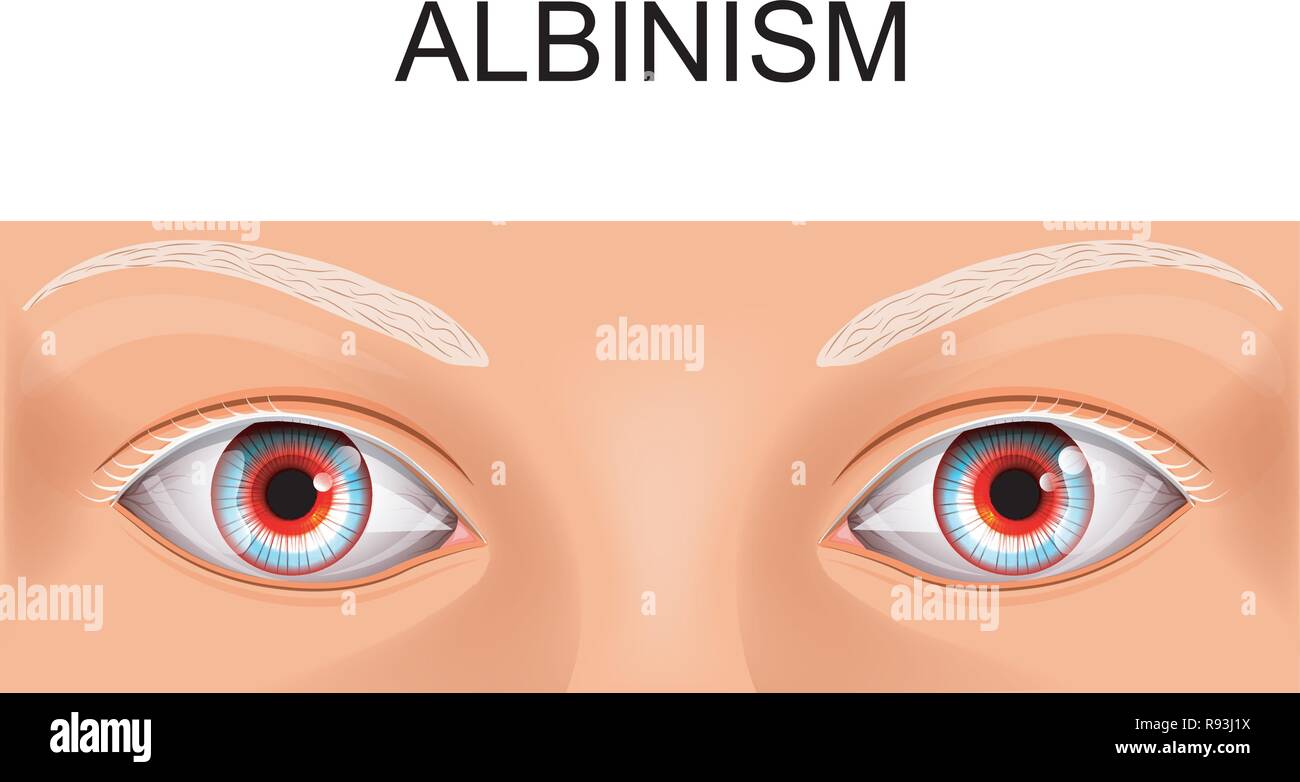 caucasian albino eyes