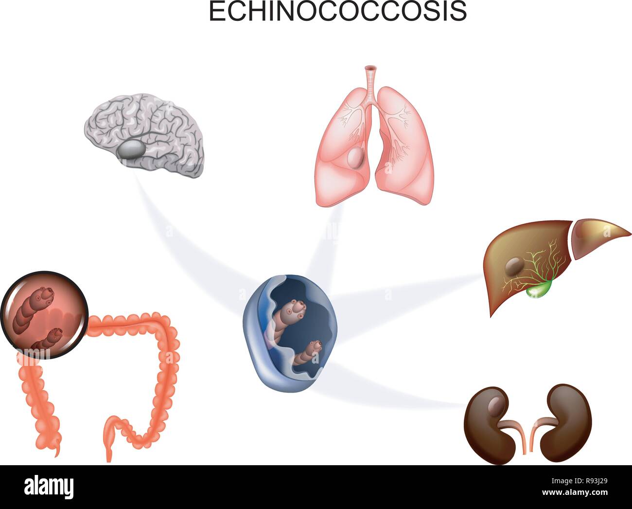vector illustration of hydatid cyst of the brain, liver, lungs and kidneys. the causative agent Echinococcus Stock Vector