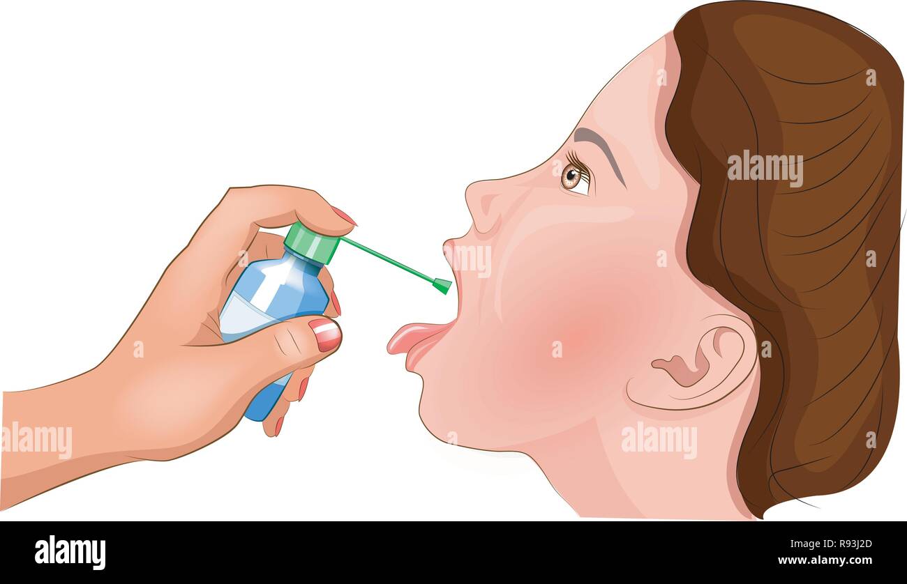 vector illustration of treatment of the tonsils with an antiseptic Stock Vector