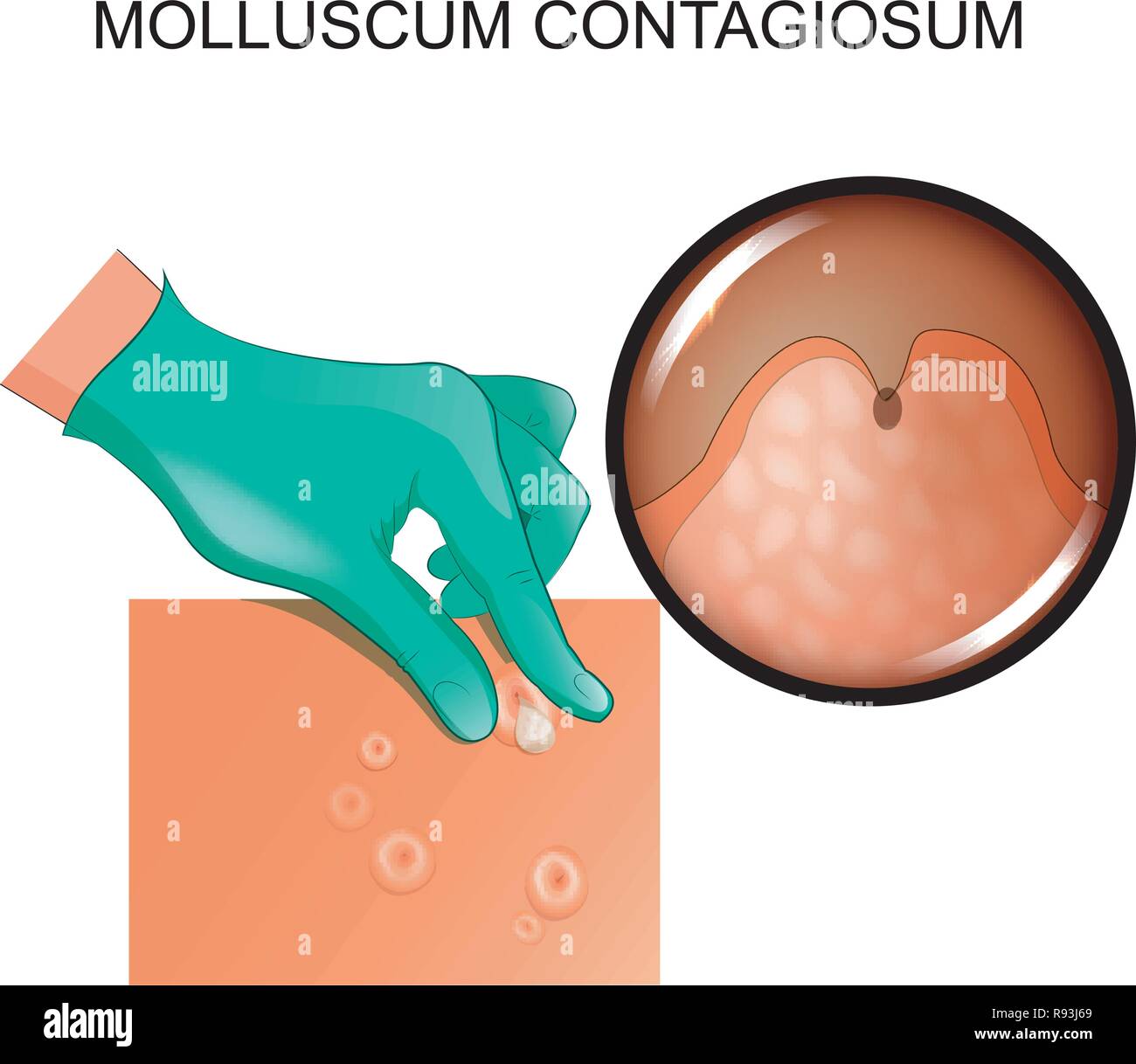 vector illustration of molluscum contagiosum. infection of the skin Stock Vector