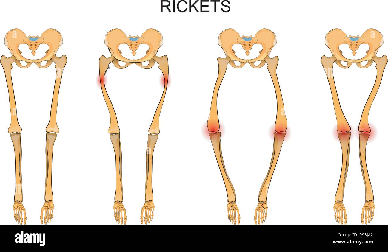 vector illustration of skeleton of the lower limbs in rickets Stock Vector