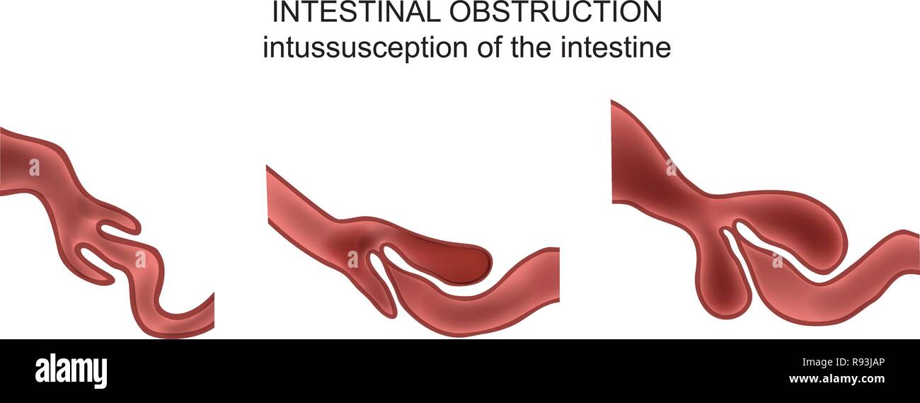 vector illustration of intussusception of intestine. obstruction Stock ...