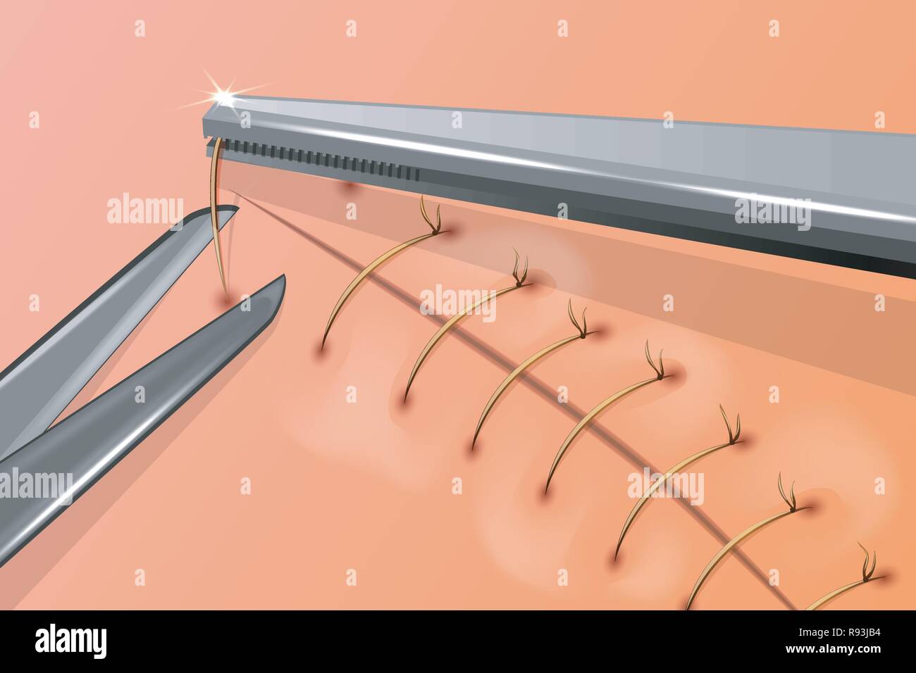 vector illustration of removal of surgical stitches Stock Vector
