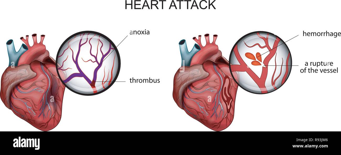 vector illustration of a myocardial infarction. thrombosis and hemorrhage Stock Vector