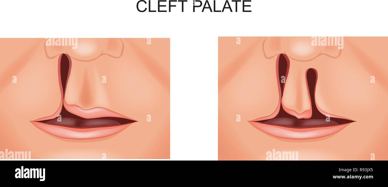 vector illustration of the face of a child with a defect cleft palate Stock Vector