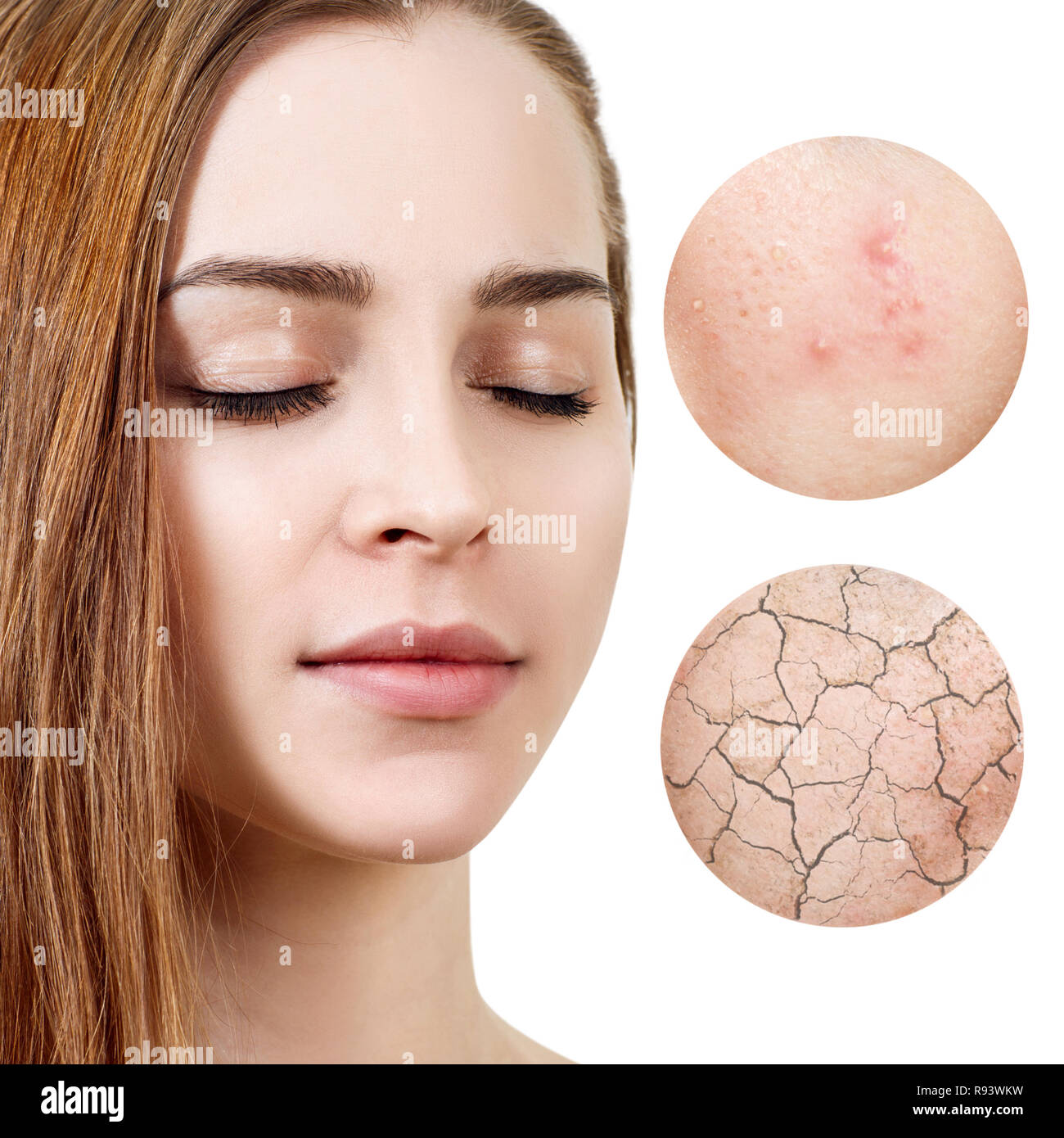 Zoom Circles Shows Problem Skin Of Young Woman Stock Photo Alamy