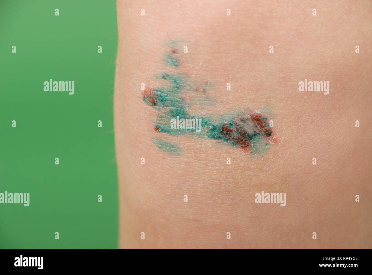 Child scraped knee hires stock photography and images Alamy