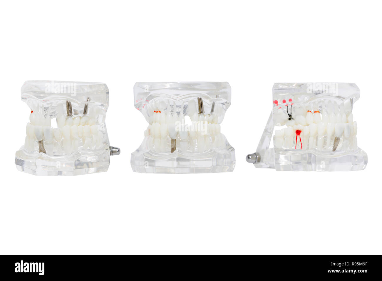 Dental implant in the gum. Isolated on white Stock Photo Alamy