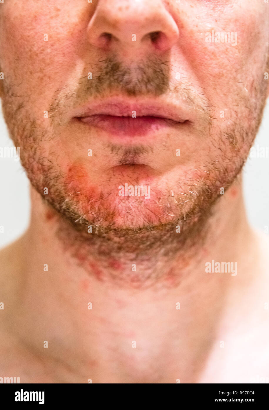 Man with seborrheic dermatitis in the beard area Stock Photo
