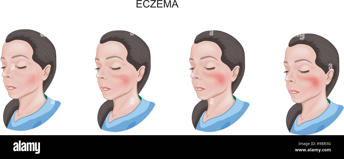 vector illustration of eczema face skin. dermatology Stock Vector
