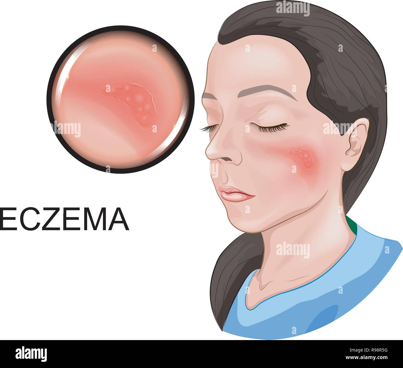 vector illustration of an eczema of a face Stock Vector