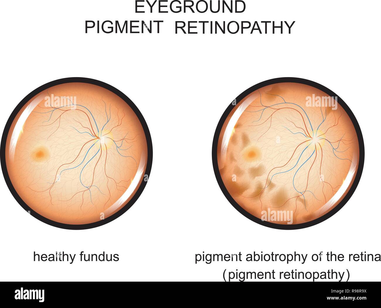 vector illustration of the fundus. pigment retinopathy Stock Vector
