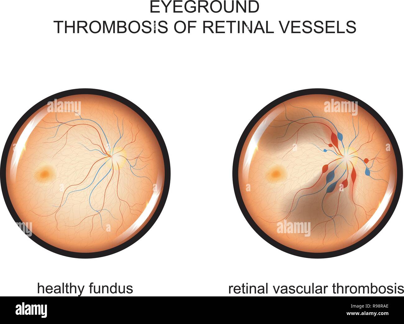 vector illustration of the fundus. retinal vascular thrombosis Stock Vector