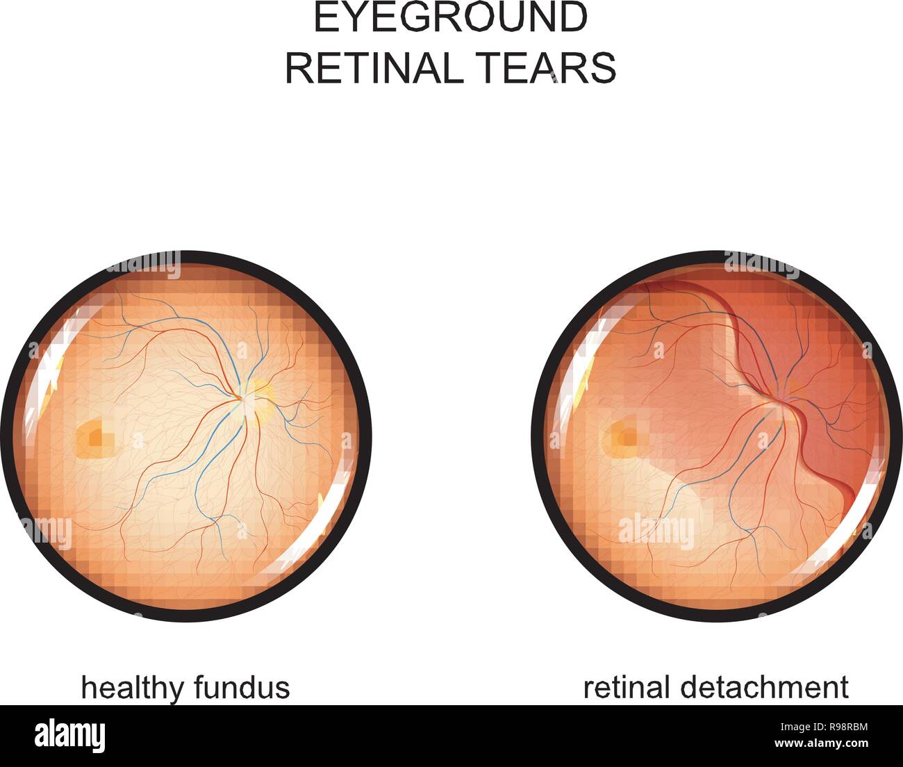 vector illustration of the fundus. retinal tears Stock Vector
