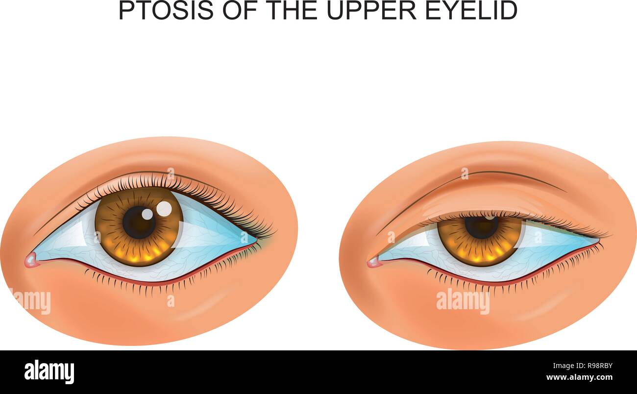 Ptosis meaning