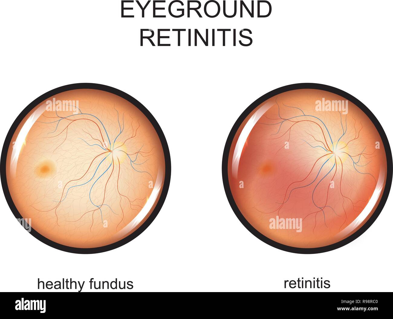 vector illustration of the eye fundus. retinitis Stock Vector
