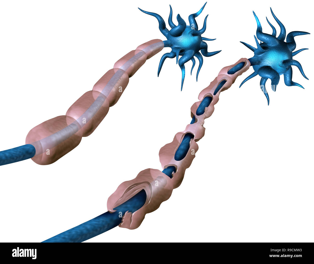 Multiple sclerosis demyelination myelin Cut Out Stock Images & Pictures ...