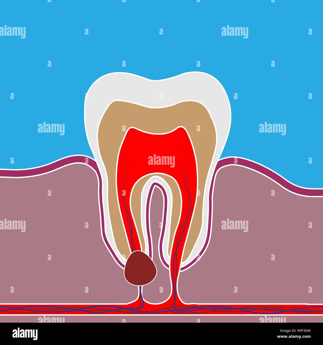 Flat style of dental disease with pain and inflammation. Medical