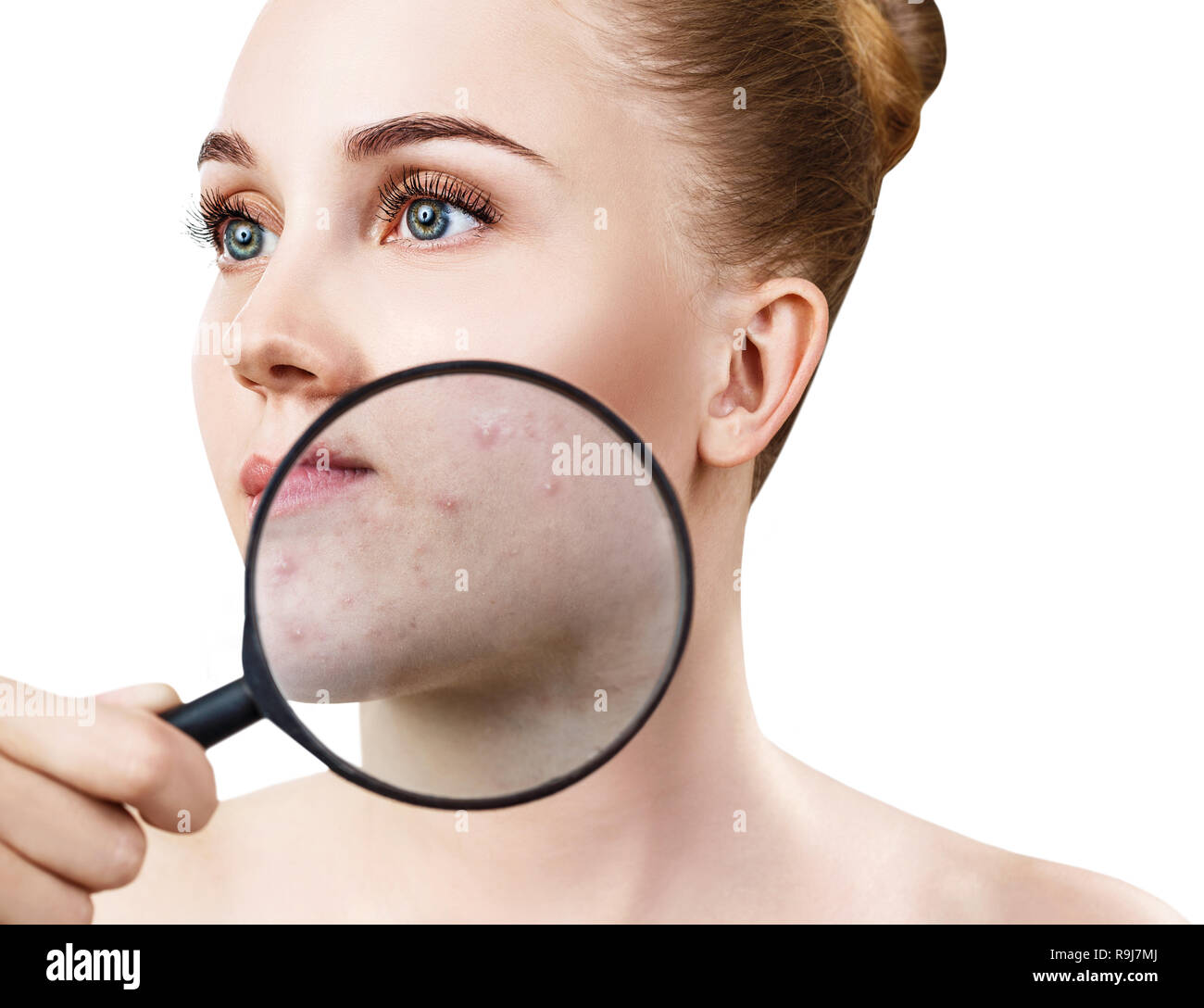 Young woman with magnifying glass shows skin with acne. Stock Photo
