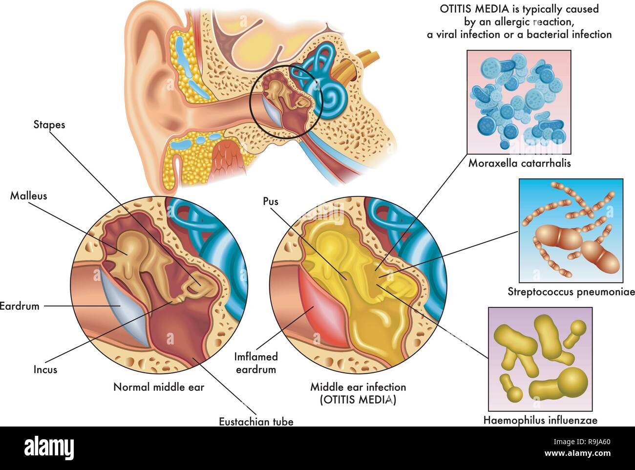 Medical illustration of the symptoms of otitis media Stock Vector