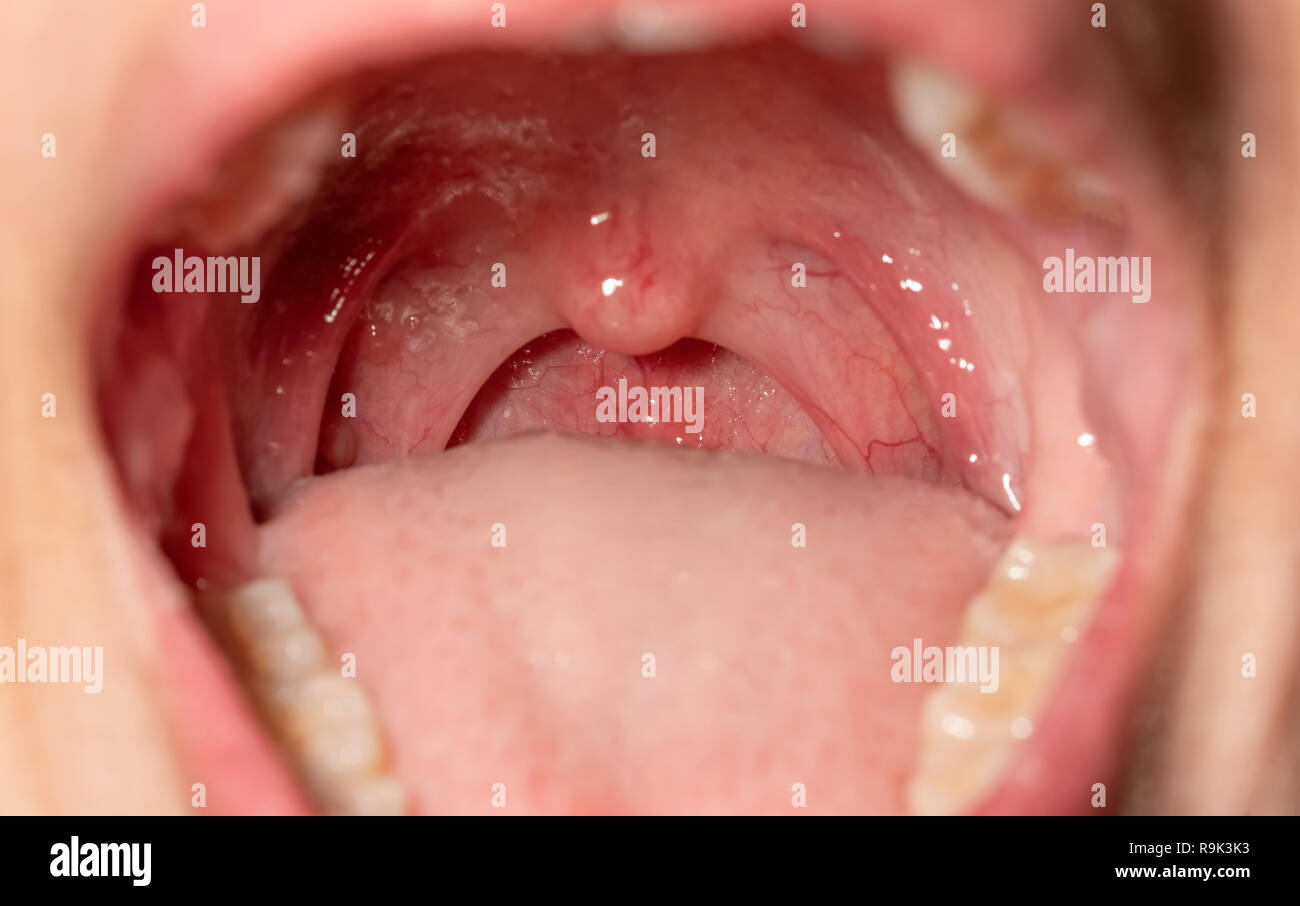 Sore throat with throat swollen. Closeup open mouth with posterior pharyngeal wall swelling and uvula and tonsil. Influenza follicles in the posterior Stock Photo