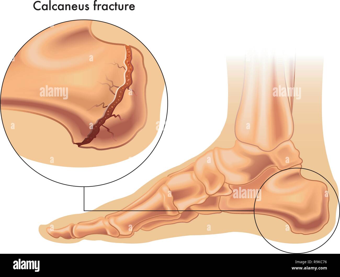 medical illustration the symptoms of calcaneus fracture Stock Vector
